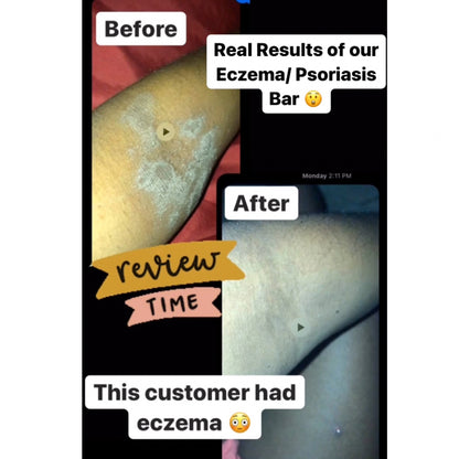 Eczema/Psoriasis Relief Soap